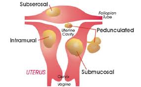 Uterine Fibroid Remedy